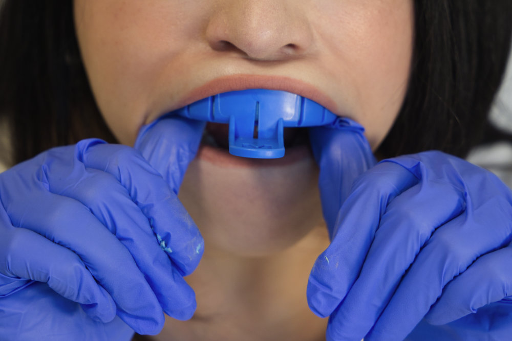 A women pushing the upper impression tray up into her mouth with her thumbs.