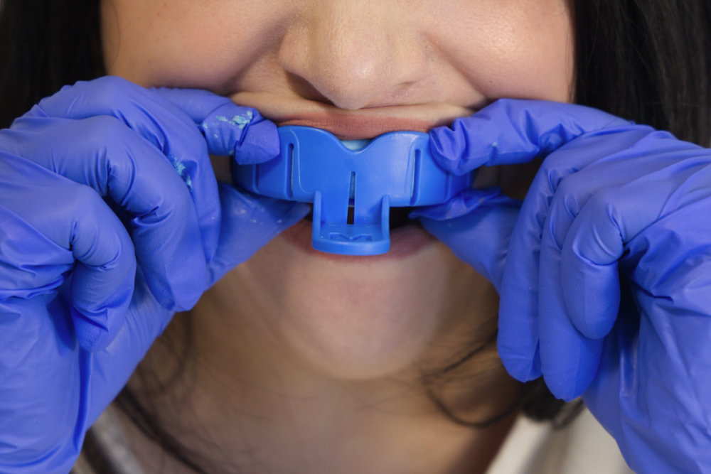 A women inserting the upper impression tray into her mouth.