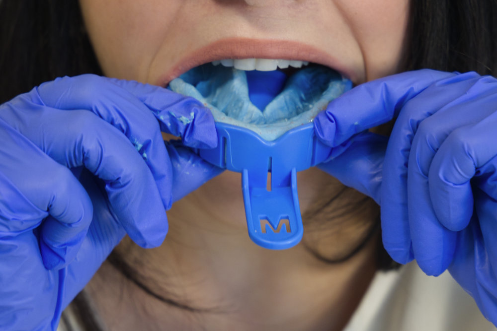 A woman wearing gloves showing a finished upper Smiles.Club impression kit tray.