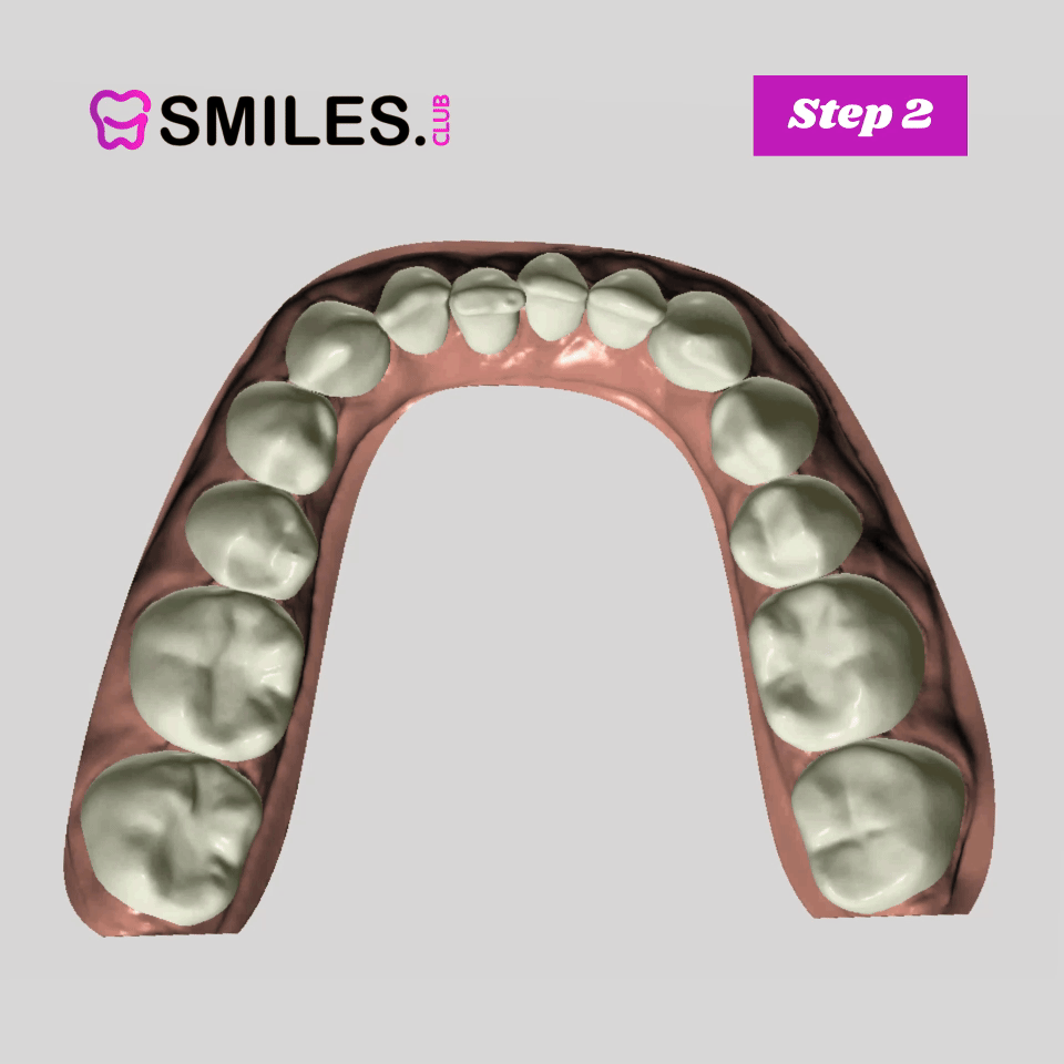 Clear Aligner Step 2 mouth moving aimation