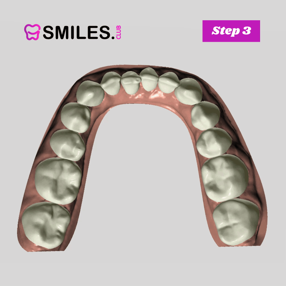Clear Aligner Step 3 mouth moving aimation